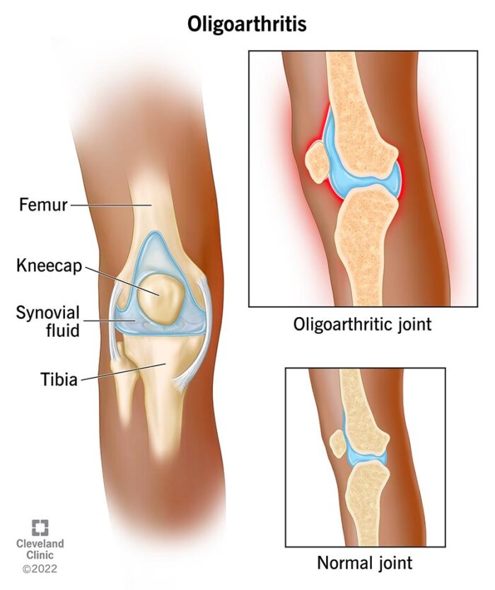 23929-oligoarthritis